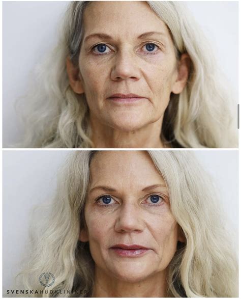 Före och efter.